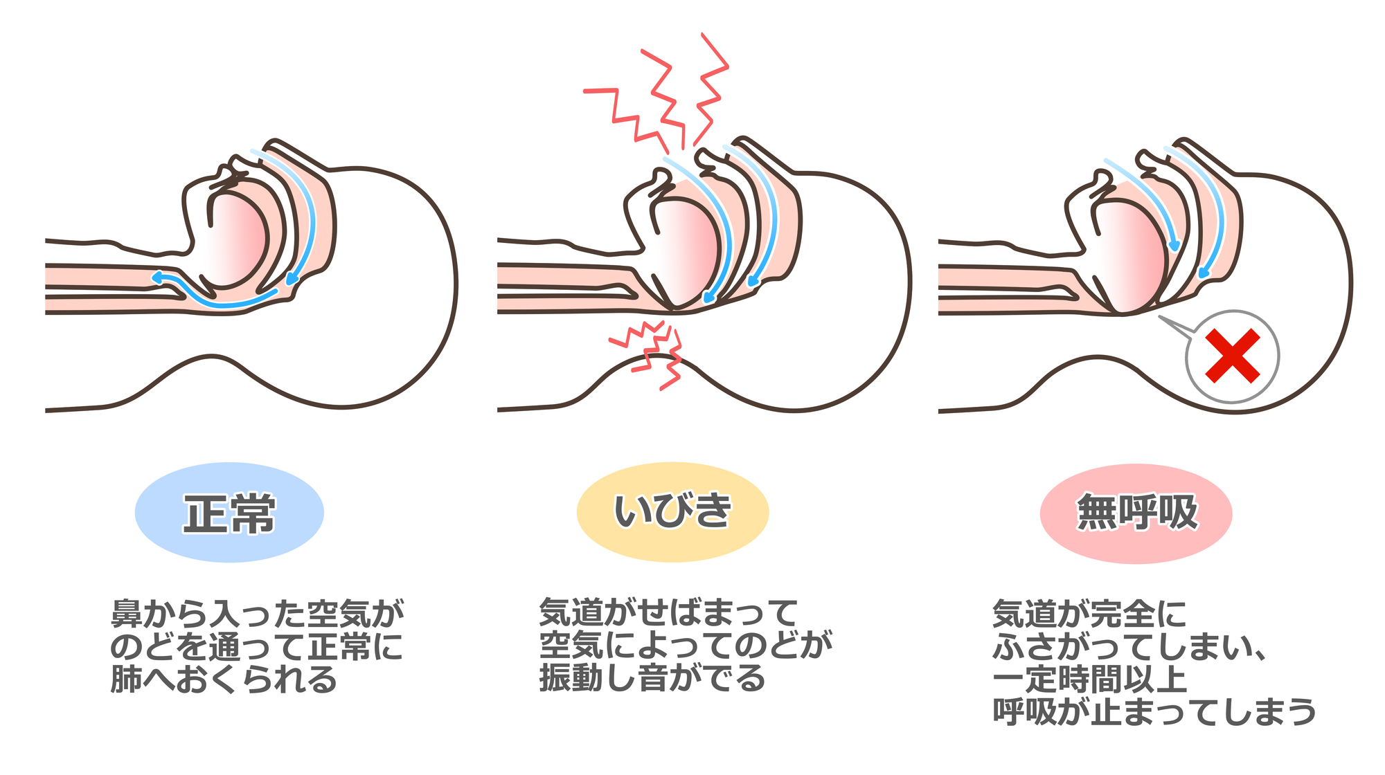 飯田橋の歯医者-飯田橋エトワール歯科医院の睡眠時無呼吸症候群